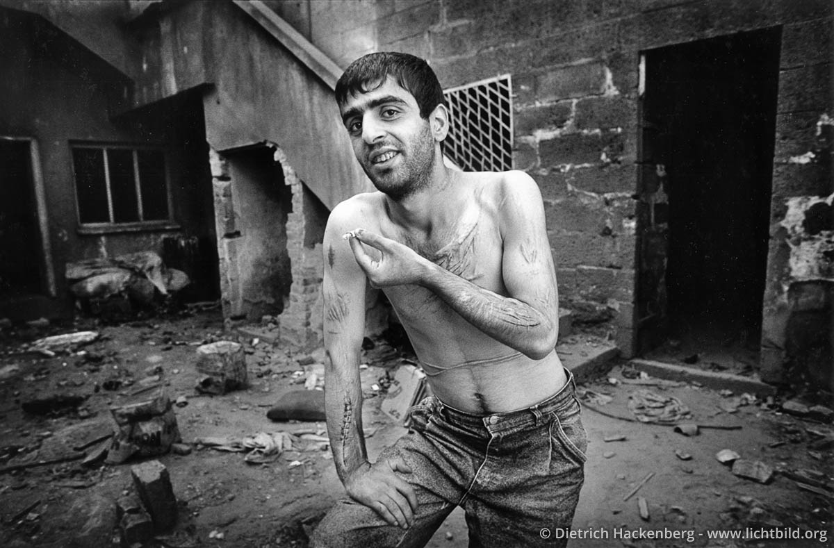 Kurdischer junger Mann mit Narben - Diyarbakir, Türkei 1991 - Junkie und Krimineller, der sich seine Wunden auch selbst zugefügt hat. - Foto © Dietrich Hackenberg
